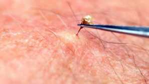 Първа помощ в ухапване от насекоми, змия и изгаряне от медузи